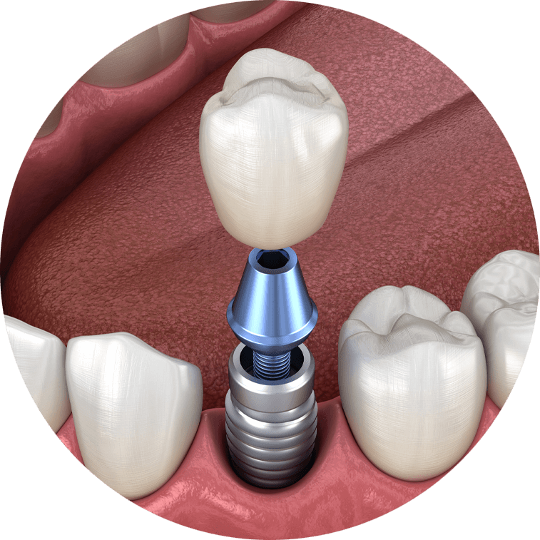St Pete Dental Implant Center Full Mouth Dental Implants St Petersburg, FL